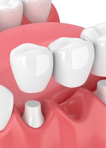 Dental Restorations Clinic in vikaspuri